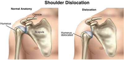 ShoulderDislocation_SM
