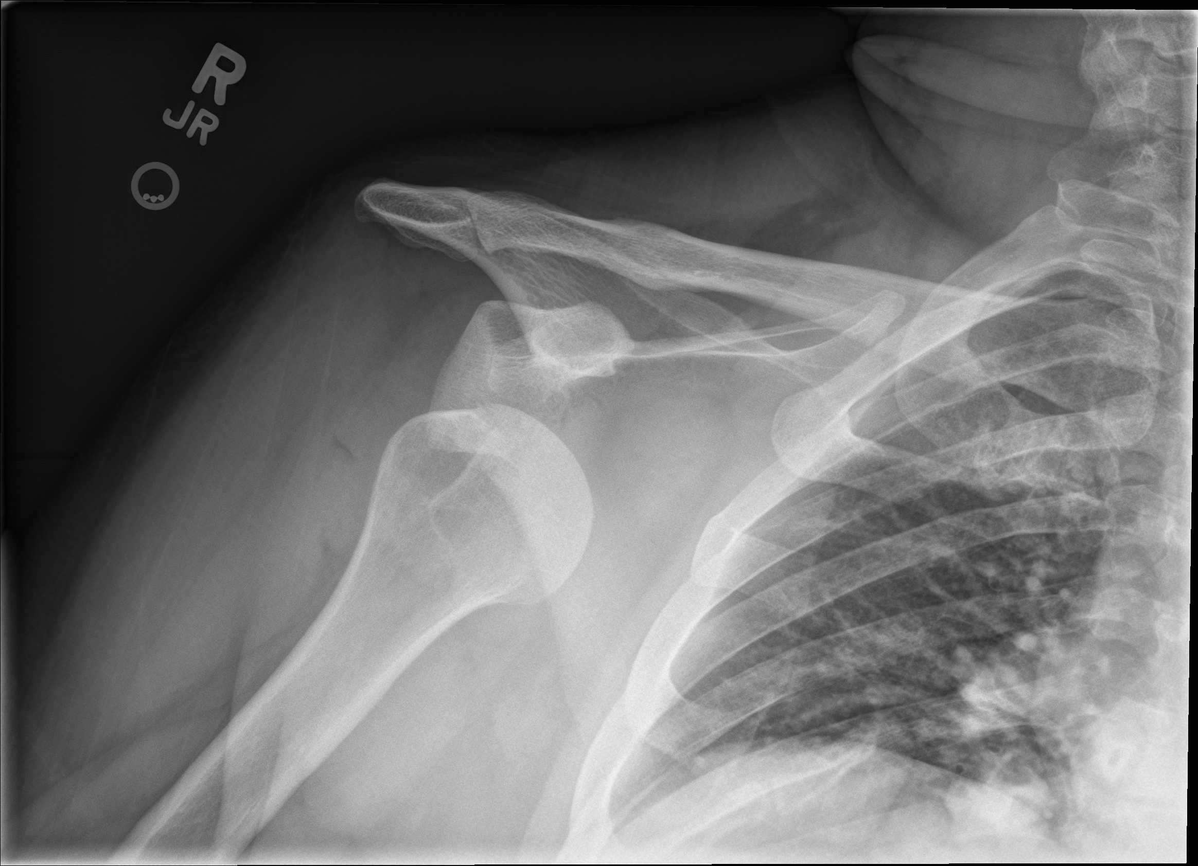 shoulder-disloc-2