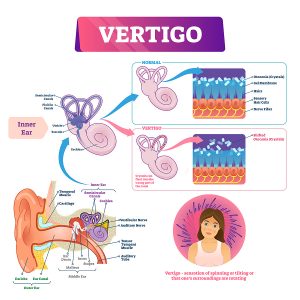 Vertigo meaning