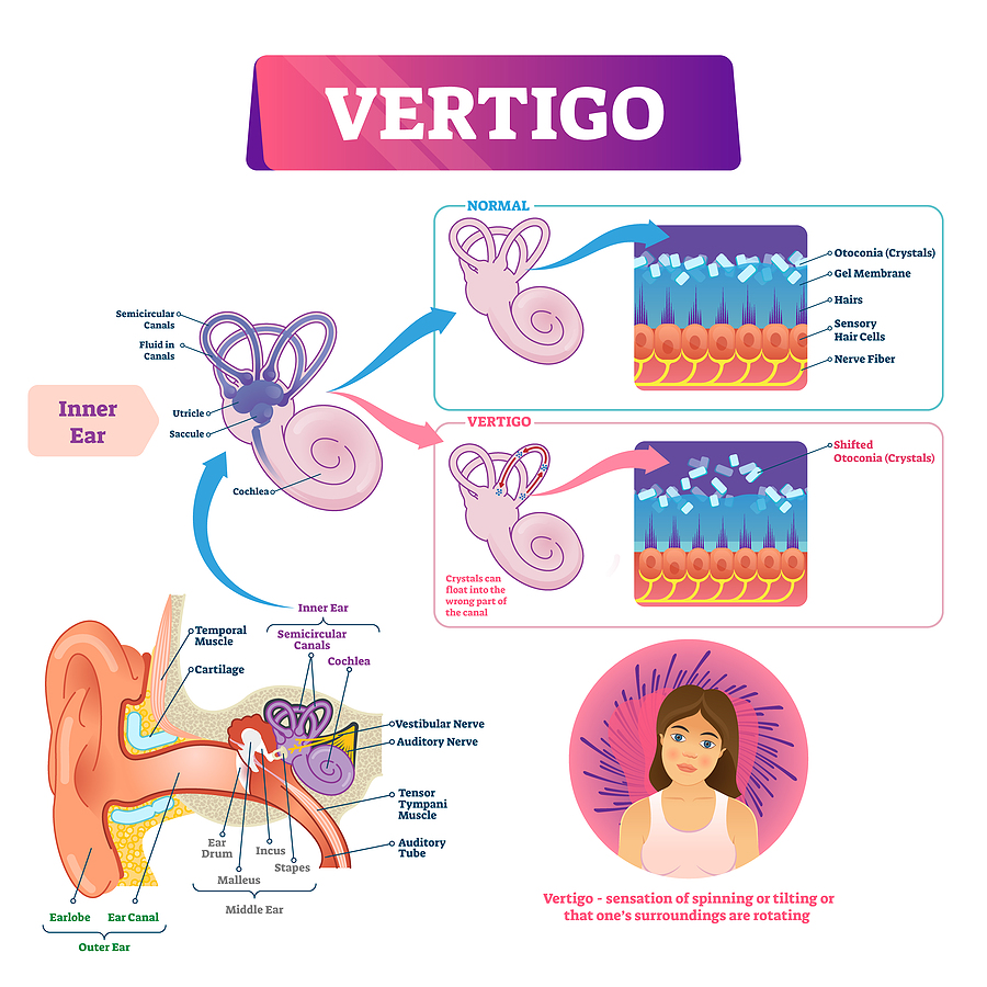 Vertigo Vector Illustration. Labeled Medical Vestibular Ear Prob